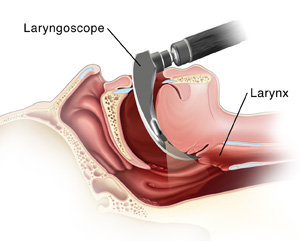 Lateral view of head and neck with direct laryngoscope in place, with anatomy ghosted in.  SOURCE: Original KPC art
referenced from:
http://www.med.umich.edu/anes/tcpub/glossary/anesthesia_glossary-14.htm
http://www.besthealth.com/besthealth/surgery/english/pages/100167.html?CFID=43642817&CFTOKEN=41529062
http://quincymedgroup.adam.com/content.aspx?productId=13&pid=13&gid=100167
http://www.mybwmc.org/library/2/9503
