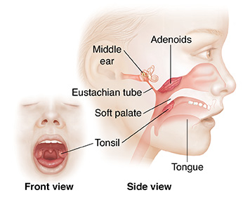Anterior view of child's open mouth with tonsils. Lateral view of child's face showing tonsils, adenoids, and inner ear.  SOURCE: Original art, elements from ASkin_20141107_v0_001. Used in 82425, elements in 4A11934, 5A940374, 11A12193, 6A940374, 11B12193, versions in 6A940374, 6B940374,15B12193, 11B12193, 15A12194, 15A12193.