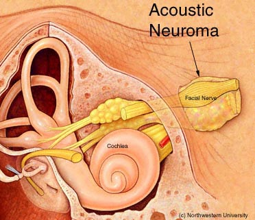 Acoustic Neuroma1s2w