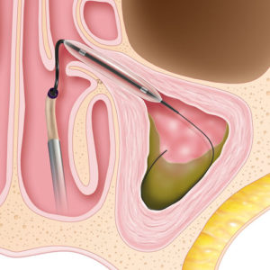 Balloon-Sinuplasty-300x300