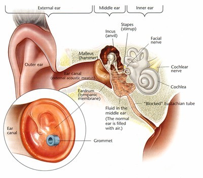 Myringotomy