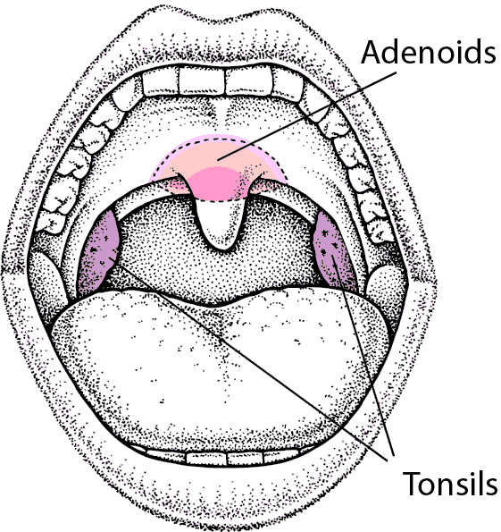 PED_tonsils_adenoids