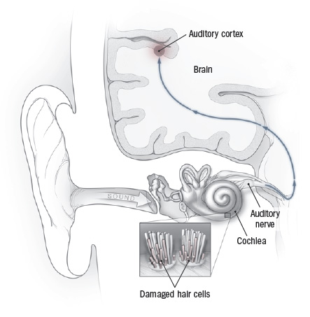 Tinnitus