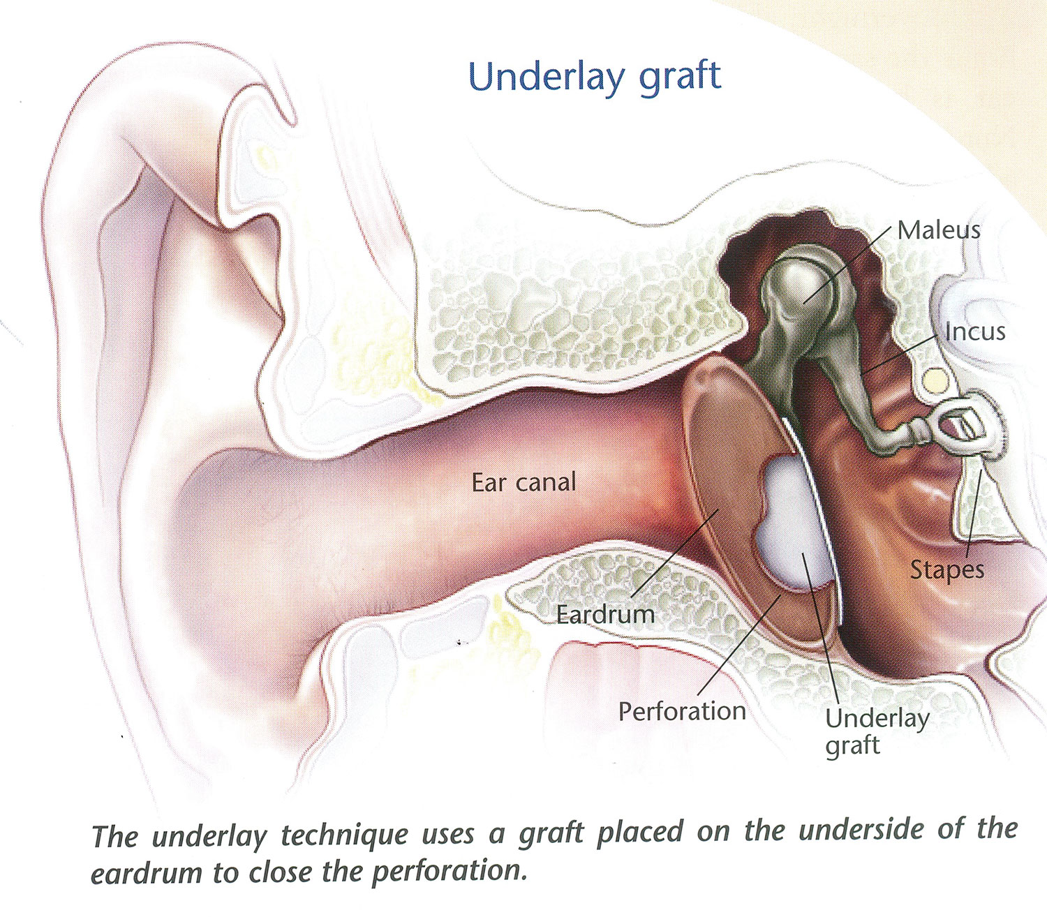 mitec-myringoplasty