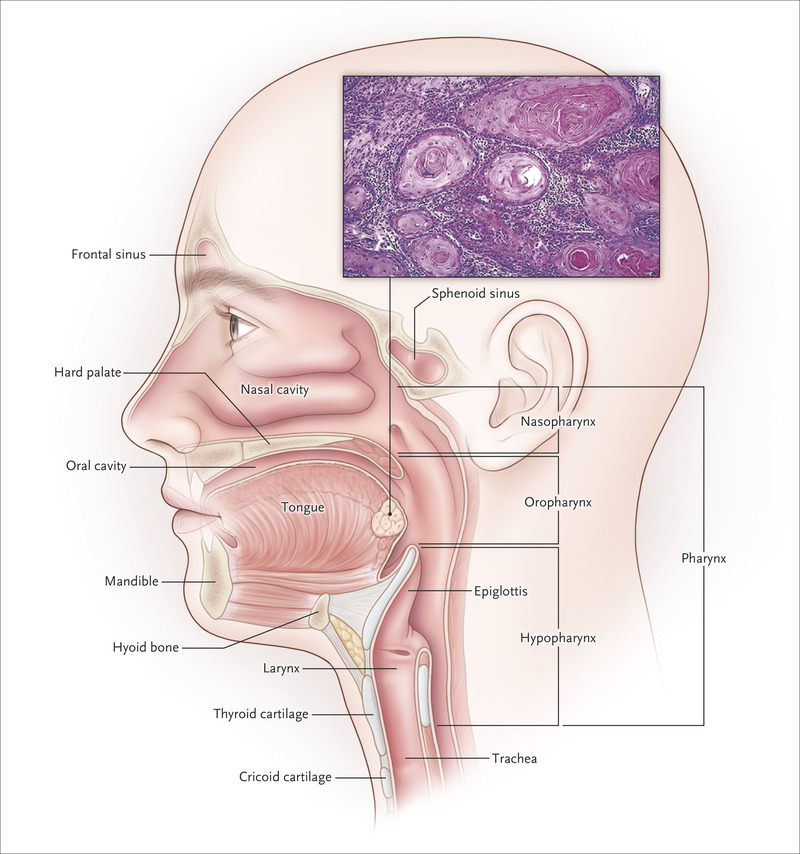 nejmra1715715_f1