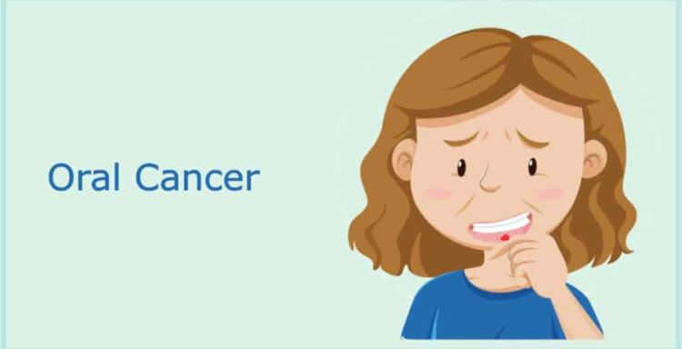 Mouth cancer (sore treatment in bangalore