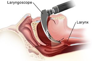 Lateral view of head and neck with direct laryngoscope in place, with anatomy ghosted in.  SOURCE: Original KPC art
referenced from:
http://www.med.umich.edu/anes/tcpub/glossary/anesthesia_glossary-14.htm
http://www.besthealth.com/besthealth/surgery/english/pages/100167.html?CFID=43642817&CFTOKEN=41529062
http://quincymedgroup.adam.com/content.aspx?productId=13&pid=13&gid=100167
http://www.mybwmc.org/library/2/9503