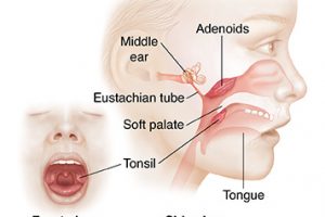 Anterior view of child's open mouth with tonsils. Lateral view of child's face showing tonsils, adenoids, and inner ear.  SOURCE: Original art, elements from ASkin_20141107_v0_001. Used in 82425, elements in 4A11934, 5A940374, 11A12193, 6A940374, 11B12193, versions in 6A940374, 6B940374,15B12193, 11B12193, 15A12194, 15A12193.
