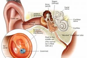 Myringotomy
