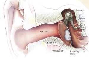 mitec-myringoplasty